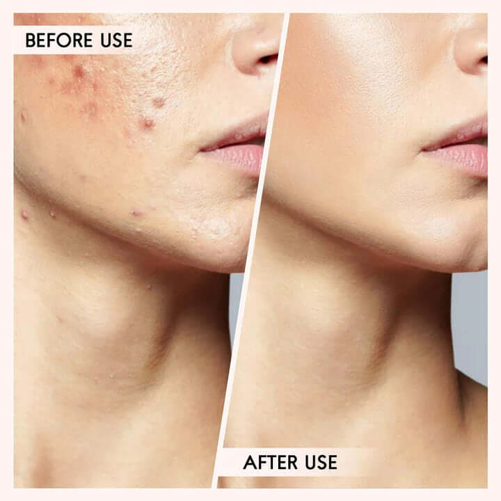 Hochwertiges Mitesser & Pickelentfernungs-Set für reine Haut